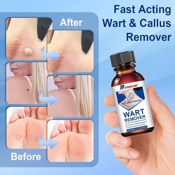 17% Salicylic Acid Liquid Wart Remover, Corn, Callus 1 floz, Fast Acting - Picture 2 of 4
